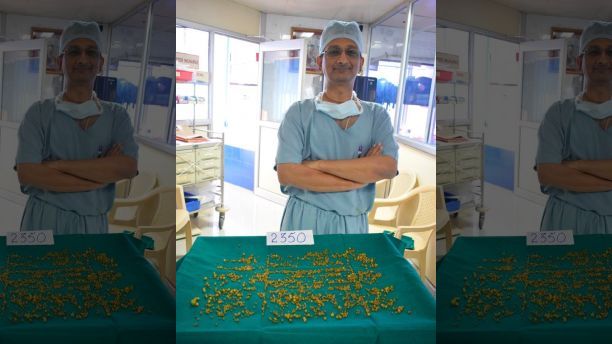 A team of doctors led by Laparoscopic Surgeon Dr. Bimal C Shah at Bhaktivedanta Hospital in Mira Road, a suburb of Mumbai in India, removed a whopping 2,350 stones from a 50-year-old womanâs abdomen. See SWNS story SWSTONES; For more than one and a half years, the patient a resident of Mumbai had been in the know about the presence of stones in her gallbladder after a check-up with local doctors for severe pain in her abdomen in November 2016. However, she did not act on the doctorâs advice for a surgery and looked for alternate methods. But, when the pain persisted and became intolerable in the last few months, she approached Dr. Shah. âShe was admitted earlier this month, and an ultrasound confirmed what was found in the earlier investigations,â said Dr. Shah. The surgery was conducted in mid-March. âGallstones, measuring up to 10 to 12 millimeters were removed through surgery which lasted about 30 minutes,â said he.