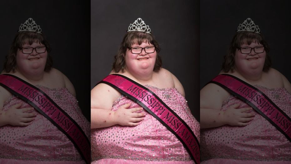 A 15-year-old girl who weighs 380 lbs due to a rare condition called Prader-Willi Syndrome has been crowned a pageant queen. 
