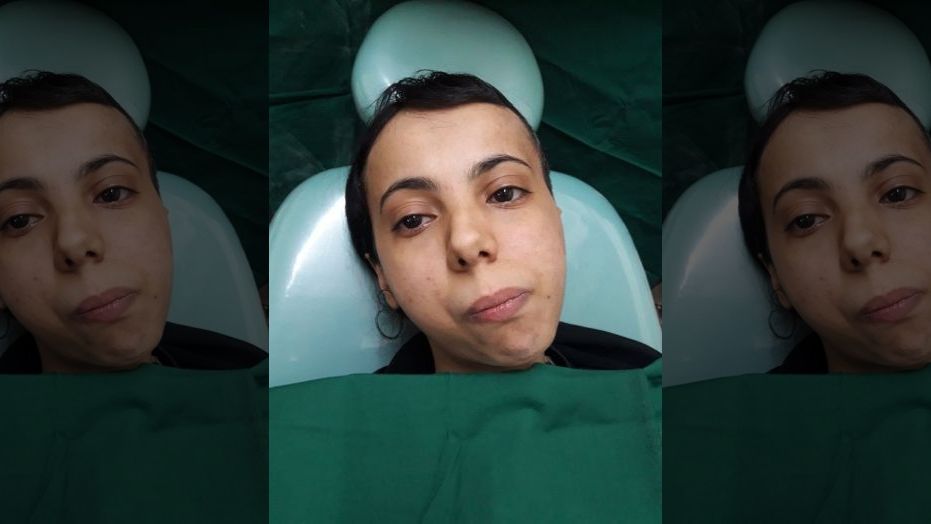 A woman has eaten solid food for the first time in her life, 30 years after her jaw was fused shut by a tumor.