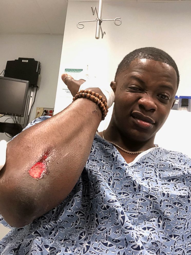 PHOTO: James Shaw Jr. shows injuries he received when he stopped a gunman from continuing to fire in a Tennessee Waffle House, April 22, 2018 in Nashville, Tenn.