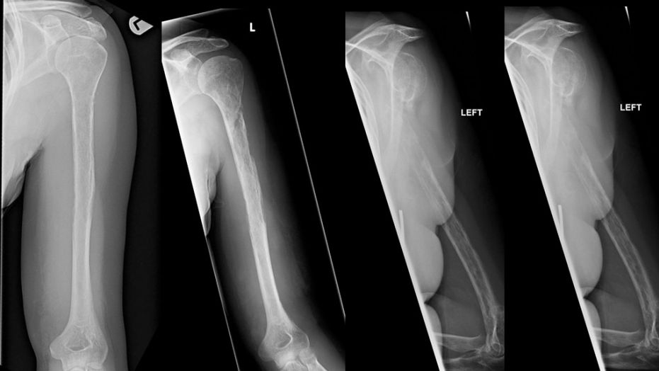 X-rays taken of a woman with so-called “vanishing bone disease” showed her bones gradually passing from sight on the images, according to a Live Science report. 