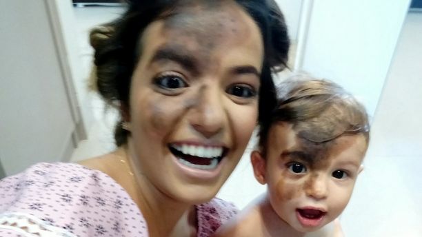 Carolina Giraldelli with her son Enzo Cestari who was born with a large birthmark on his face. Carolina has had an identical mark painted on her face in solidarity with her child. See SWNS story SWMARK; A mum paid tribute to her adorable son by having a perfect replica of his birthmark painted on her face so she could walk in his shoes for a day. Little Enzo Cestari, one, was born with a dark birthmark covering most of his forehead and stretching down one side of his nose. His mum Carolina Giraldelli, 26, from CÃ¡ceres, Brazil vowed to never hide his unique mark and to make sure he knew he was perfect just the way he was. The businesswoman ask a professional make up artist to perfectly replicate her son's birthmark on her own face to celebrate his uniqueness.