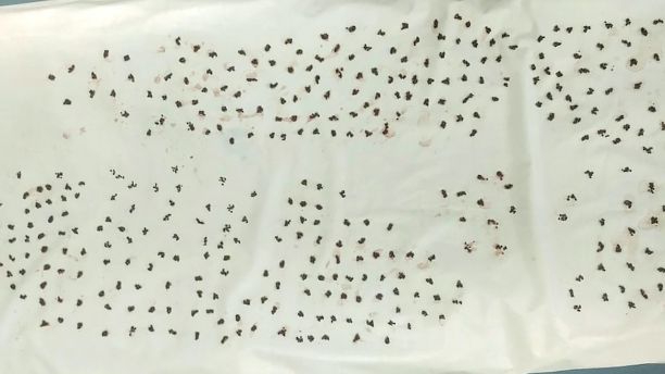 4100 gallstones removed from Yogesh Yeole entire gall bladder. See SWNS story SWSTONE; Doctors remove 4,100 stones gallstones from one man in India. A searing abdominal pain made 43-year-old Yogesh Yeole of Nashik in Maharashtra, India, rush to Krishna Hospital in the same city, where the doctors after carrying out various tests did an emergency surgery to realize that 4100 stones were occupying his gallbladder, blocking the bile flow and causing the severe pain.