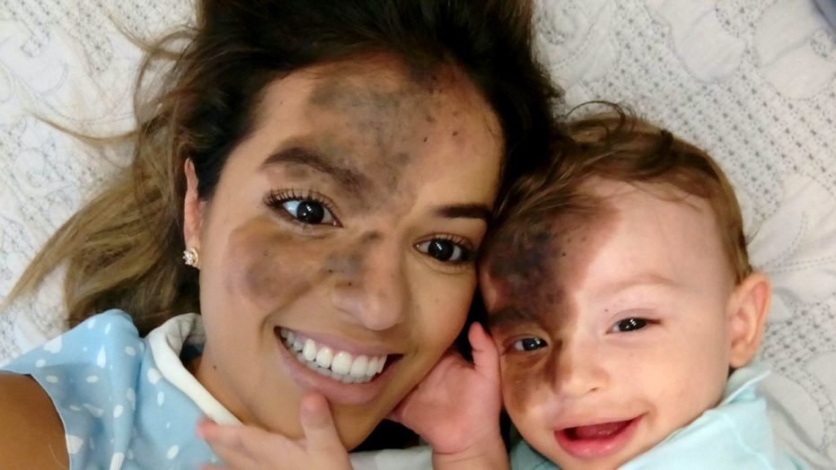 Carolina Giraldelli, whose son Enzo was born with a birthmark covering a portion of his face, asked a makeup artist to create a replica of the mark on her own face.