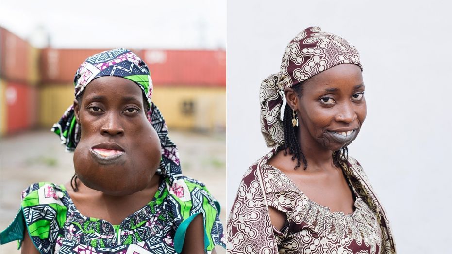 After eight years of suffering, surgeons removed a huge mass from inside Yaya's mouth that was threatening her ability to breathe.  