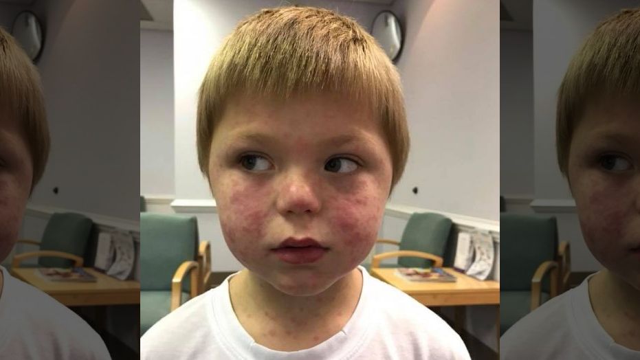 Mason McNair, 5, broke out in a rash due to the tick bite. 