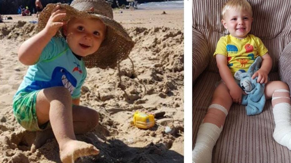 Laura Ashford said her two-year-old son, Harri, suffered severe burns after he touched the remnants of a beachfire that was buried underneath sand at a Welsh beach.