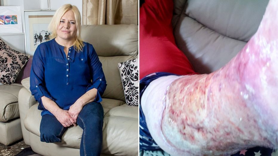 A woman who cut herself shaving got an infection so bad she had to have her leg amputated. 