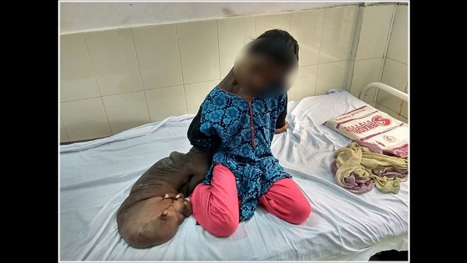 Mita Sabar, a young woman suffering from a condition that caused her hand to enlarge over roughly a decade, was admitted to a hospital on Monday.