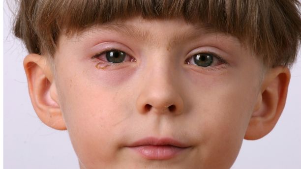 ill allergic eyes - conjunctivitis