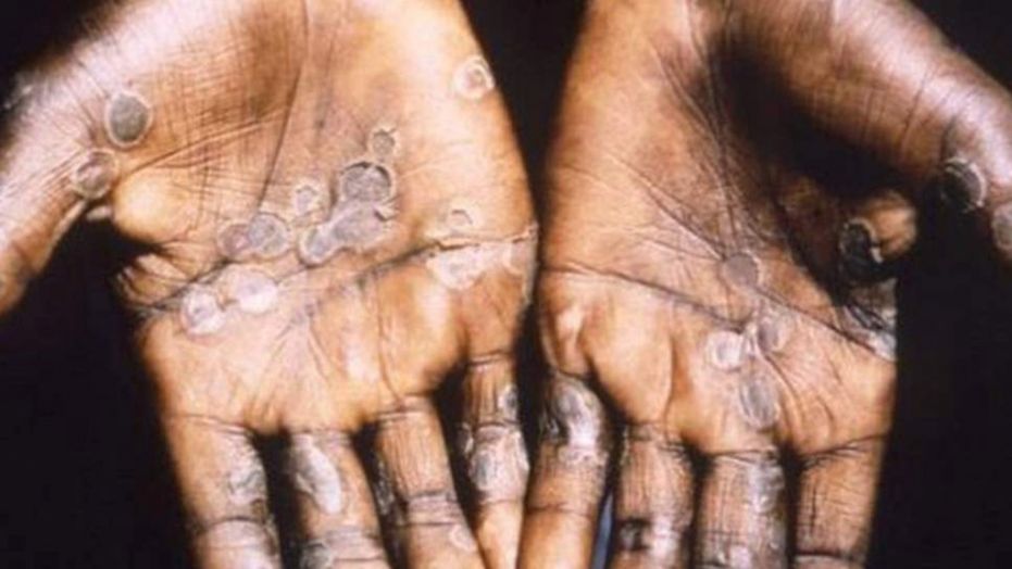 Monkeypox is considered mild and typically occurs in remote parts of central and west Africa.