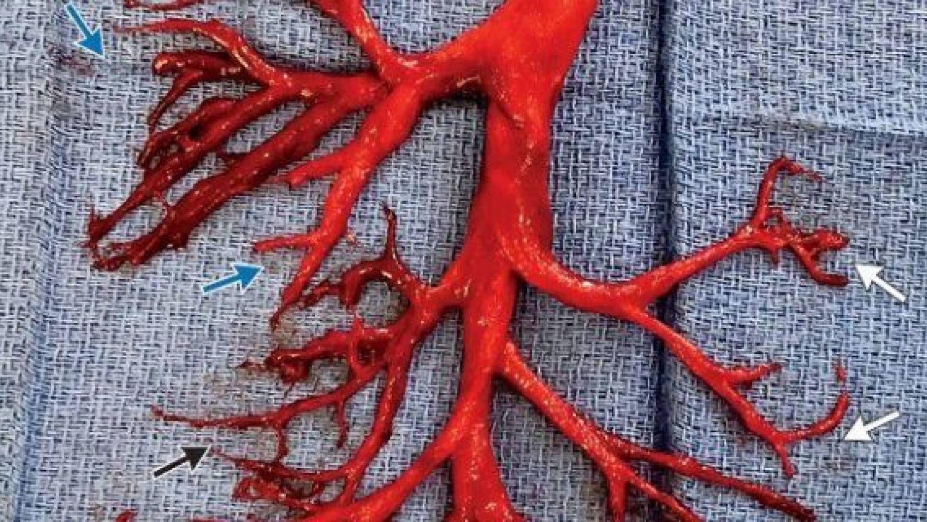 A man being treated for heart failure coughed out a cast of the right bronchial tree after doctors placed a ventricular assist device and began anticoagulation therapy.