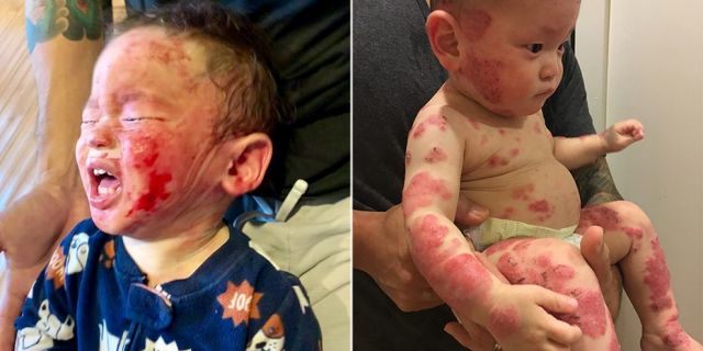 The Hawaii couple eventually determined their son was suffering from topical steroid addiction.