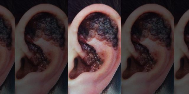 She claims doctors repeatedly dismissed an "itchy" lump she had discovered in her ear, until it began scabbing and changing color. 