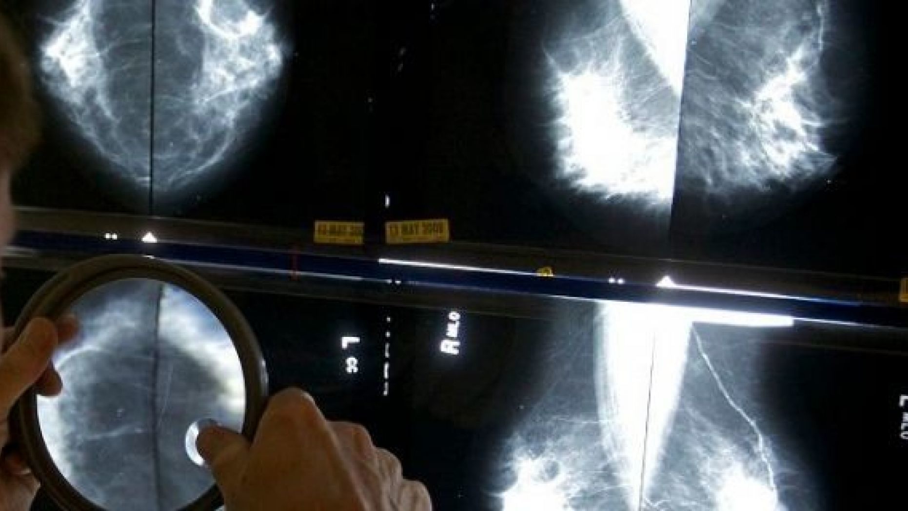 A radiologist uses a magnifying glass to check mammograms for breast cancer. (AP)
