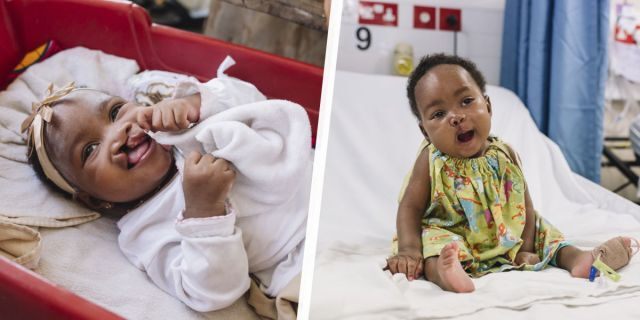 Seven-month-old Aissata and her mother came to the Africa Mercy not long ago seeking help for Aissata's cleft lip, which could have caused serious health and nutritional problems down the line.