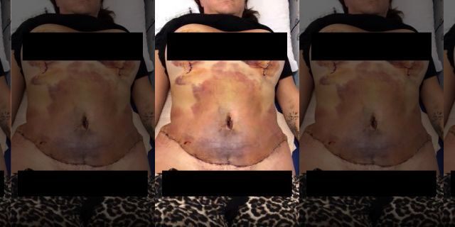 Harrison said within days of the surgery her tummy swelled up with liquid, and a week later she underwent emergency surgery to clean and drain the deeply infected wound.
