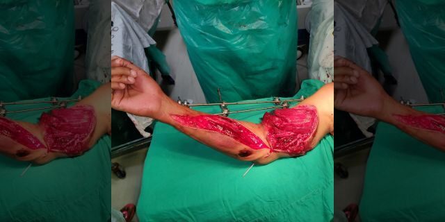 Surgeons worked for seven hours to reattach his arm.