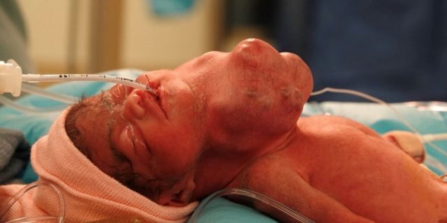 Baby Jenessa is pictured moments after her birth before surgeons successfully removed the mass that had been restricting her airway and jeopardizing both her and her sister's health.