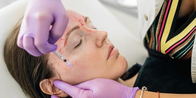 Vampire facials, officially known as Platelet Rich Plasma (PRP) therapies, involves extracting platelets from a client’s blood and injected those platelets back into the patient’s face through micro-needling for what some believe to be rejuvenative purposes.