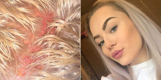 Schofield's claims have been refuted by the hairdresser, who has not been identified but said the reaction could have happened with any hairdresser. 