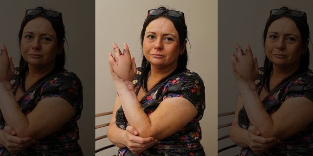 She lost a finger and has already undergone two skin grafts, but faces more procedures in the future.