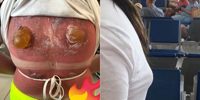 One 16-year-old girl from England was horrifically sunburned on her back while snorkeling in Cuba during a family vacation. Now recovering, the teen has since taken to Facebook to warn others of the summer sun’s dangers in a post that has since gone massively viral with over 20,000 comments to date.
