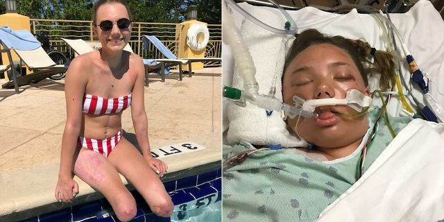 Schaffer, pictured recently on the left and shortly after the explosion on the right, said she is proud of her body for surviving.