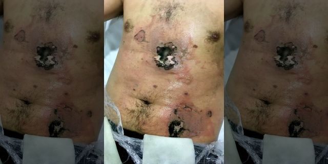 The man claims he told doctors he did not want a skin graft for his burns. (SWNS)