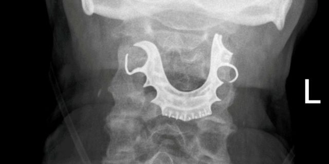 An X-ray of a patient who was left with his dentures in his throat after surgery.