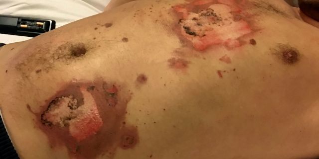 A man has told how he was engulfed in flames and left with third degree burns after his vape exploded in while he was driving. (SWNS)