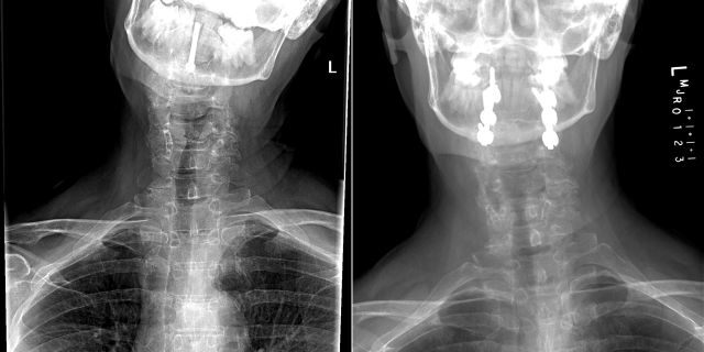 These X-rays show Bobeczko's crooked posture on the left, and the result of Lee's radical approach which involved re-breaking her neck and separating her skull from the rest of her body to realign it to the original position.