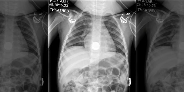X-ray of Elsie-Rose, 2, showing the battery lodged in her esophagus. (SWNS)