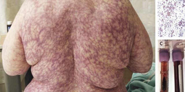 The 70-year-old woman was later diagnosed with cold agglutinin disease.