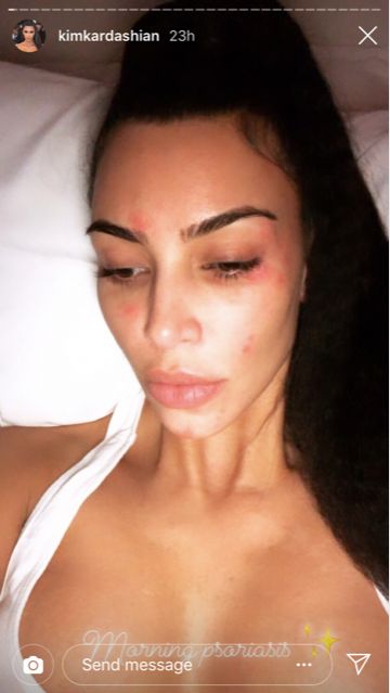 Kardashian shared a candid photo of her skin condition in March.&nbsp;