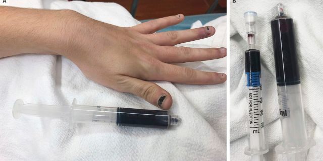 The woman's blood turned a black color after she used medication to treat a toothache.