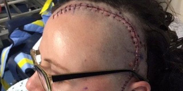 Yasmin Clapp's scar from where the tumor was removed.