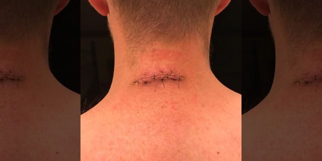 Ryan's neck after one of his initial surgeries.