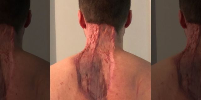 A large area of skin was removed from Ryan's back and neck.