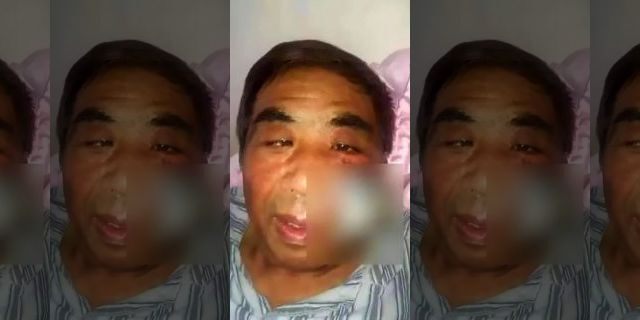 Mr. Hu's cheek was surgically removed after he scratched a mosquito bite caused his face to become infected and necrotic.