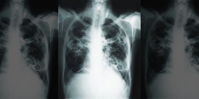 This 1966 image made available by the Centers of Disease Control and Prevention shows a chest x-ray of a tuberculosis patient. 