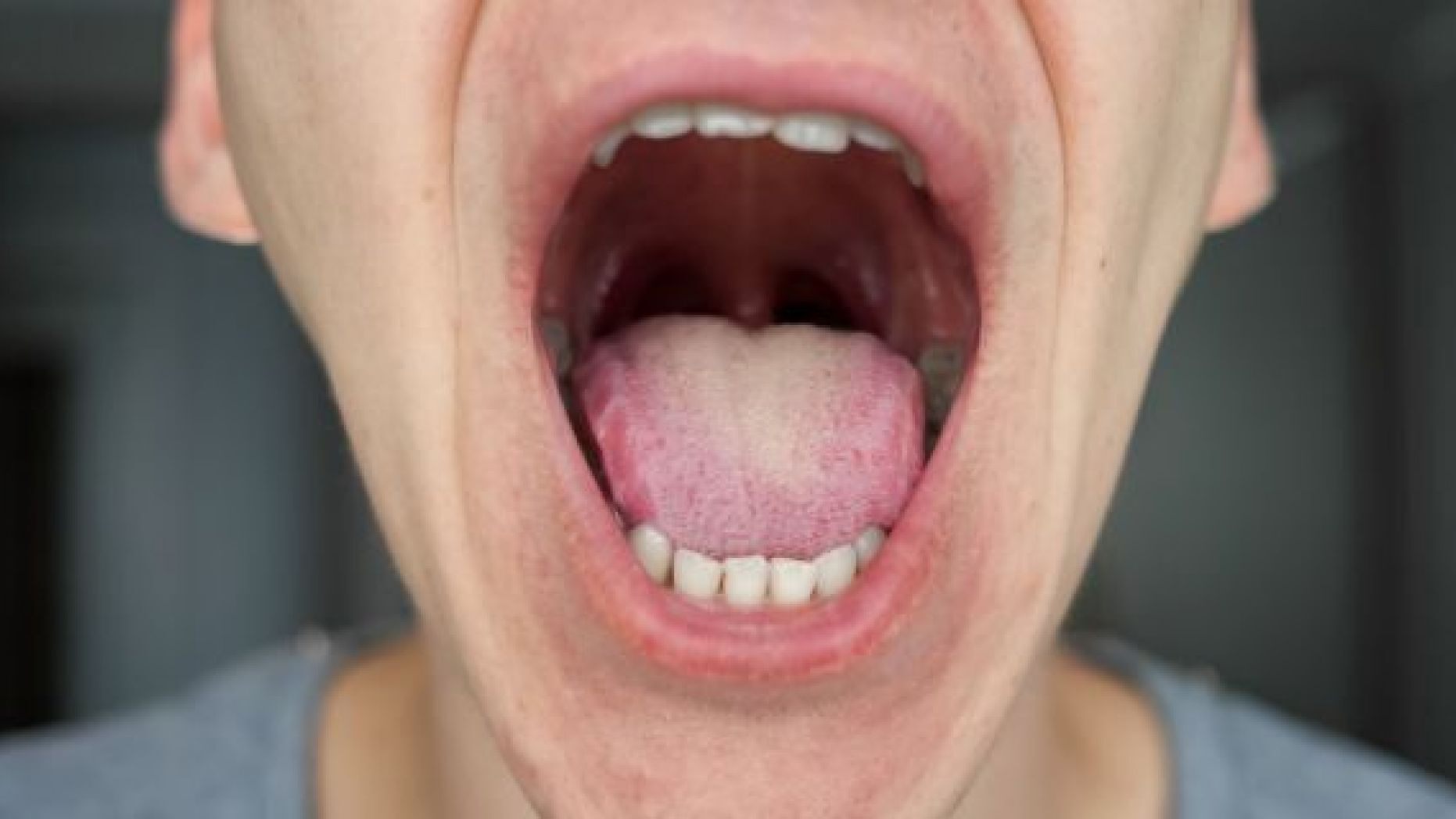 His tongue's strange appearance would turn out to be a sign of an underlying blood condition that required a relatively simple treatment,