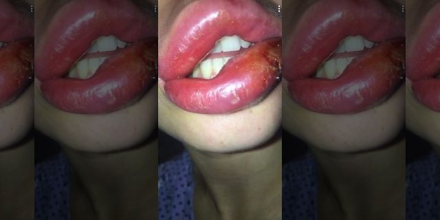 She said her lips swelled to three times the size within days. 