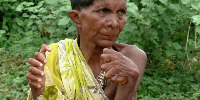 Kumar Nayak, 63, from the Ganjam district in Odisha, India, said her family was too poor to seek treatment. 