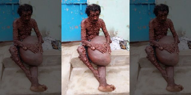 In addition to the thousands of tumors, the condition has also caused his leg to swell to a massive 56 pounds. 