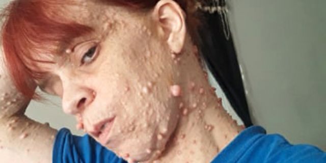 Ashley Jernigan, 35, is covered in thousands of benign tumors. 