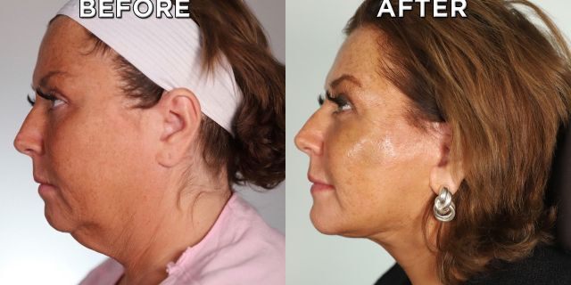 A before and after photo shows Abby Lee Miller's results from her face and neck lift.